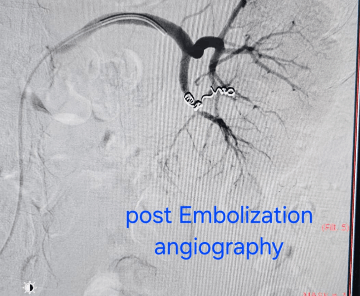 Post embolization angiography