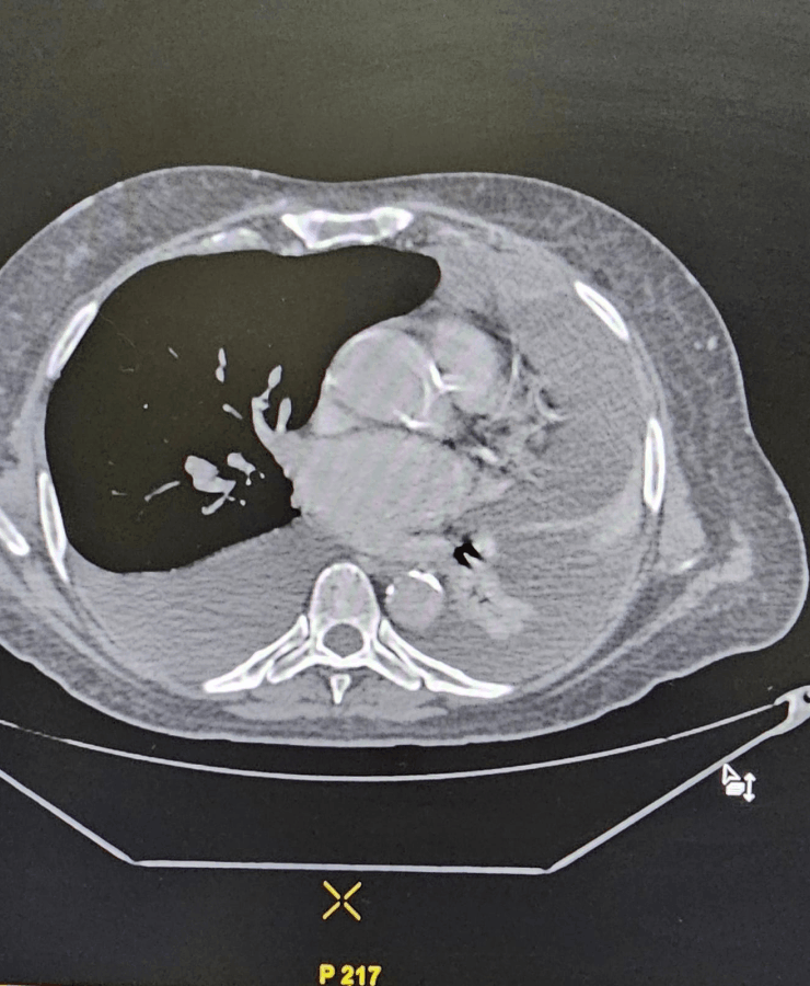 Coil mass with obliteration of aneurysm