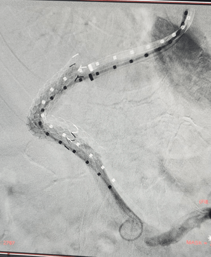 Embolization of splenic artery