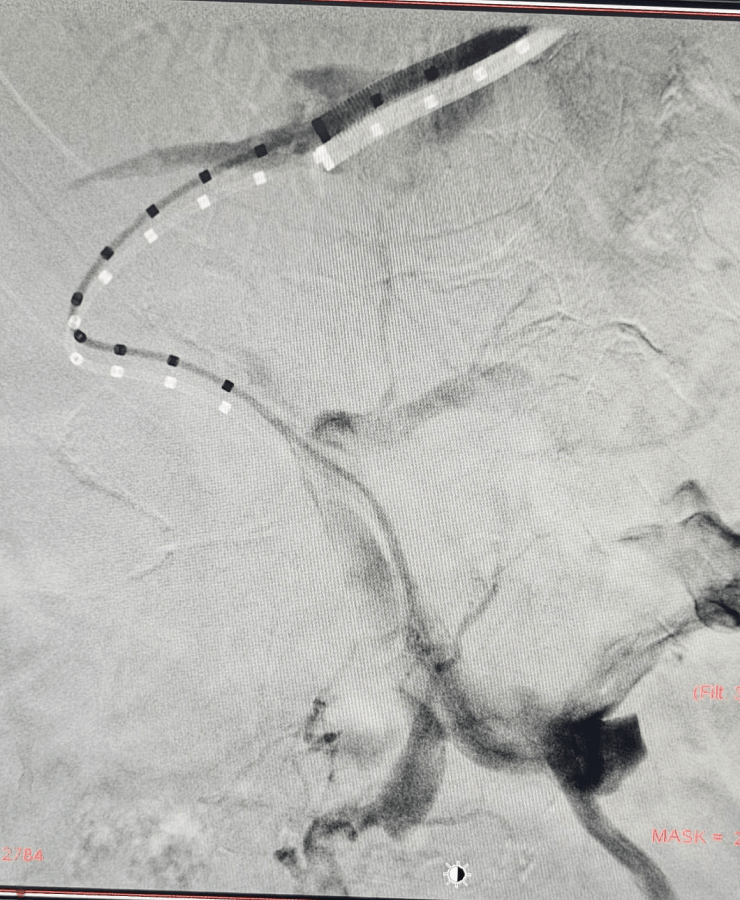 Embolization of splenic artery