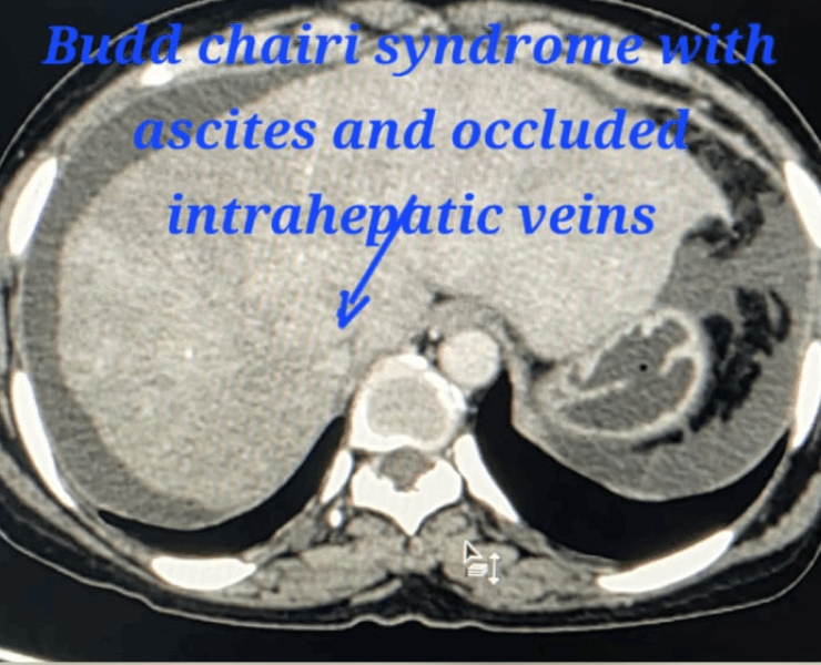 TIPS & DIPS Procedures for Liver Disease